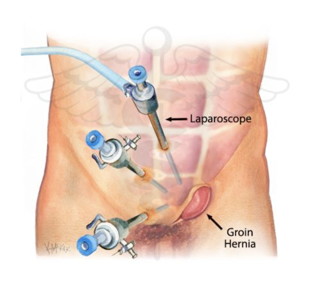 Laparoscopic hernia repair