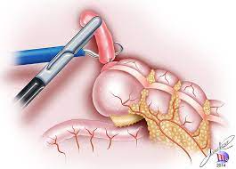 Laparoscopic appendectomy in Bhairahawa/ Butwal