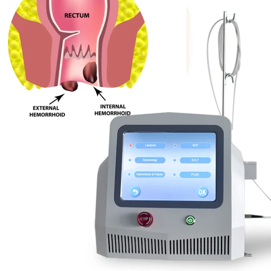 Laser Proctology in Bhairahawa