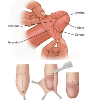Stapler circumcision in Bhairahawa