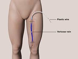 Stripping of varicose veins