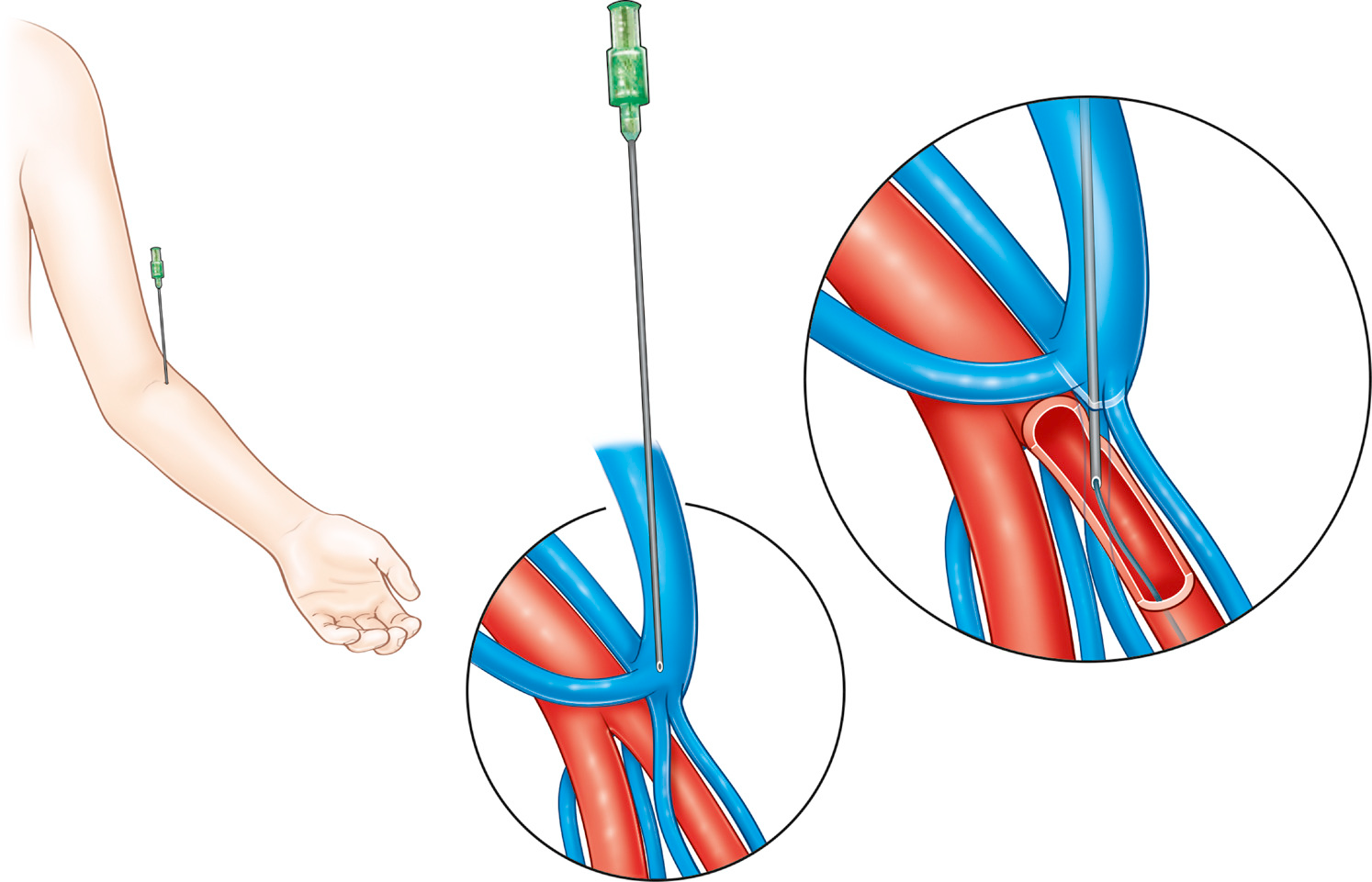 Creation of arteriovenous fistula