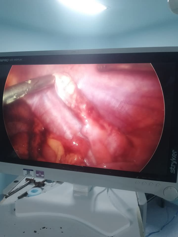 Laparoscopic Appendectomy in Rupandehi